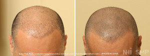 SMP Scalp Micropigment for a shaved look 