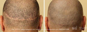 Old FUE and FUT Strip Scar addressed with SMP Scalp Micropigmenation