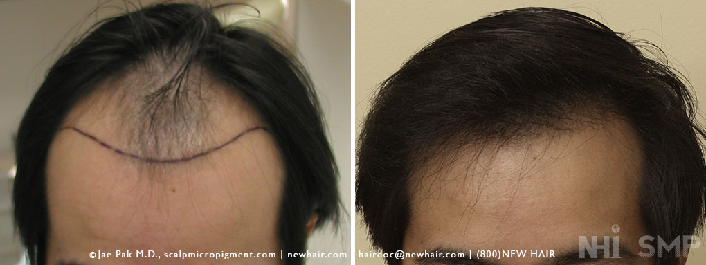 Hair Transplant In Asian Men with Before After Photos – WRassman,.  BaldingBlog