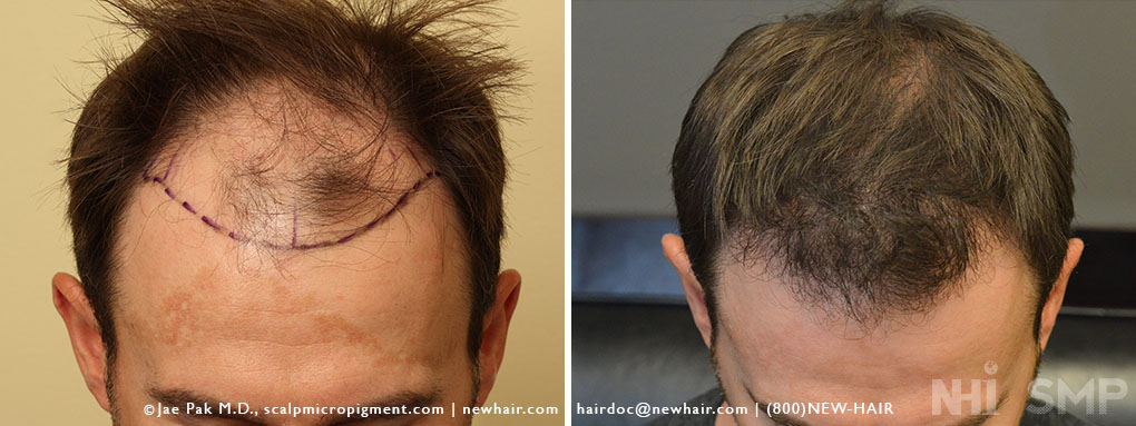 Case Report Hair Transplant with about 1500 Grafts (Before and After  Photos) – WRassman,. BaldingBlog