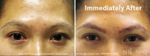 NHI Eyebrow Transplant Immediately after 300+ grafts