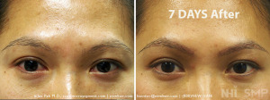 NHI Eyebrow Transplant  7 DAYS after 300+ grafts
