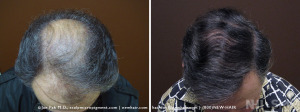New Hair Institute Review of 1657 graft  Hair Transplant 