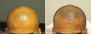 Scalp Micropigmentation to the front corners