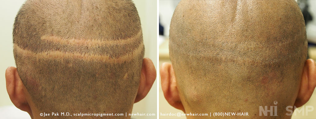 David Lee Roth's Shaved Head and Transplant Scar – WRassman,. BaldingBlog