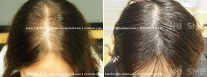 NHI_ Female_Scalp Micropigmentation SMP With Long Hair 