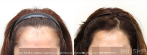 1400 graft female hair line lower and rounding by Dr. Jino Kim (NHI Seoul Korea)