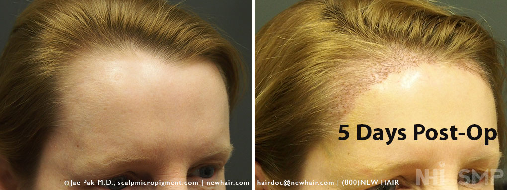 Female Hair Line Lowering Rounding Surgery (Temple Recession Correction)  With Photos – WRassman,. BaldingBlog