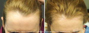 New Hair Institute Female Temple Corner Rounding 1000 grafts - 7 MONTHS Post Op 