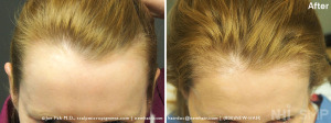 New Hair Institute Female Temple Corner Rounding 1000 grafts - 7 MONTHS Post Op