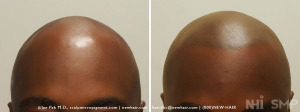 NHI Scalp Micropigmentation before after