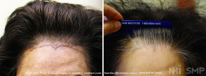 Hair Transplant for face lift scar
