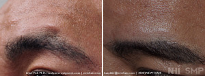 SMP to Eyebrows with Juvederm