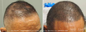 SMP to thinning hair