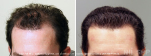 Before and After FUE Hair Transplant (NO  SMP)