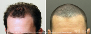 Before and After FUE Hair Transplant  AND Scalp MicroPigmentation (SMP)