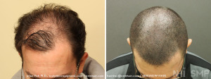 Before and After FUE Hair Transplant  AND Scalp MicroPigmentation (SMP)