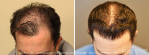 Before and After FUE Hair Transplant (NO  SMP)