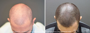 Before and After SMP - BOTH photos are after hair transplant surgery (NOTE: shaving does not make hair transplant look as full)
