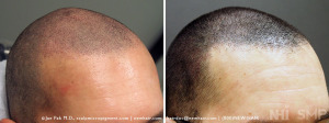 Before and After SMP - BOTH photos are after hair transplant surgery (NOTE: shaving does not make hair transplant look as full)