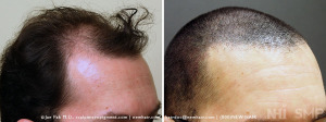 Before and After FUE Hair Transplant (WITH  SMP)