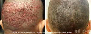 FUE immediate after/  FUE scars hidden by SMP