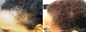SMP to traction alopecia