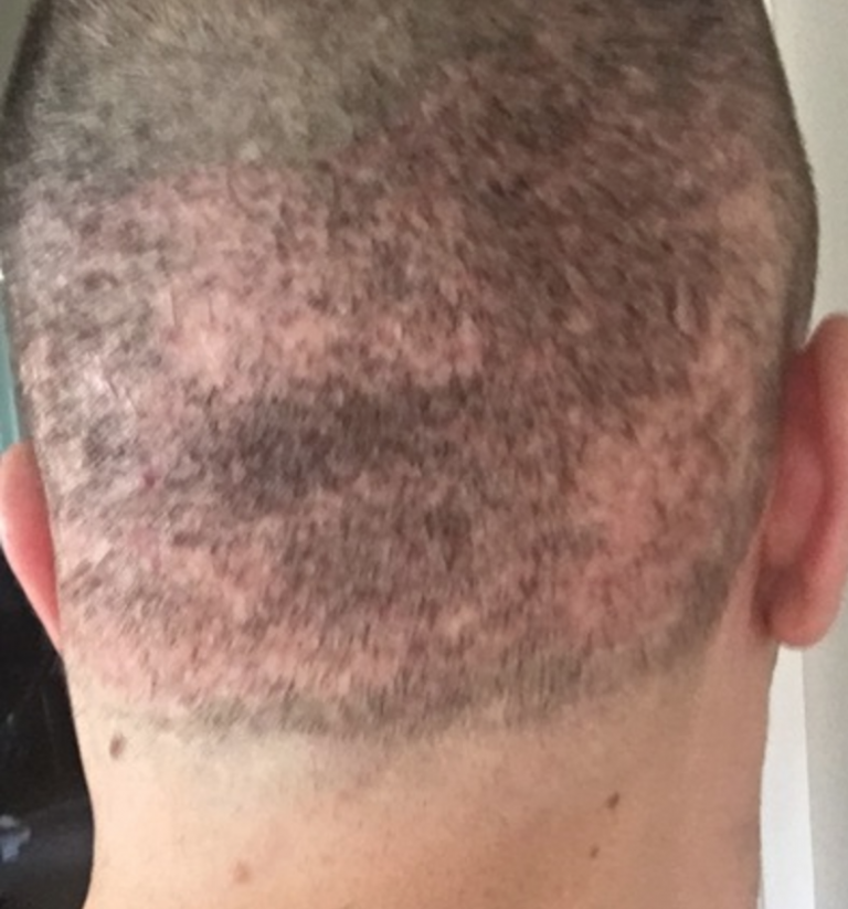 Moth eaten scars following 5000 FUE grafts – WRassman,M.D. BaldingBlog