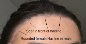 rounded female hairline with scar