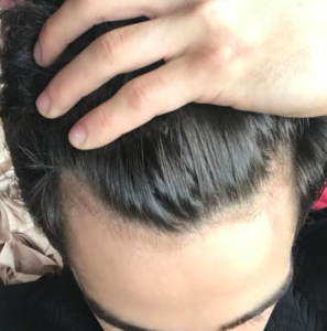 receding hairline in 18 year old suffering from early hair loss.