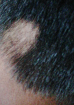 My barber found a bald spot, what is it caused by? (photo) – WRassman,.  BaldingBlog