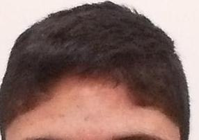 26 year old hairline