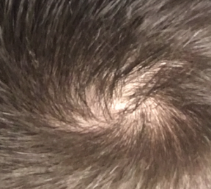 I am Asian and noticed a balding spot in my crown from a photo taken ...