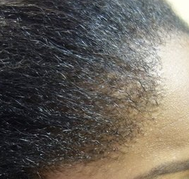 Hairline Bumps 