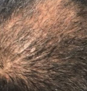 Can Dandruff affect growth from a hair transplant? – WRassman,M.D ...