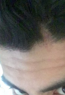 I cut my head 2 months ago, what should I do about the scar? (photo) –  WRassman,. BaldingBlog