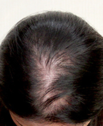 Woman with Thinning Hair Who Had Scalp Micropigmentation Done (photos ...