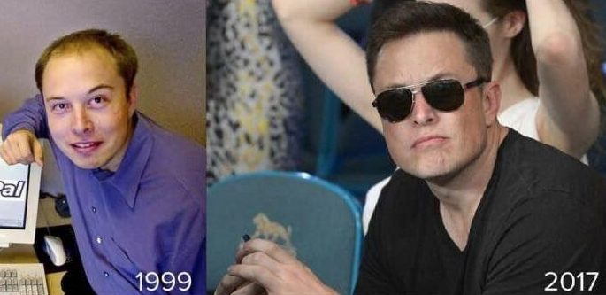 Elon Musk Before and After His Hair Transplant (Photo) – WRassman,.  BaldingBlog