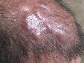 One Month After a Hair Transplant – Is This the Result or a Small Bump on  My Head? – WRassman,. BaldingBlog