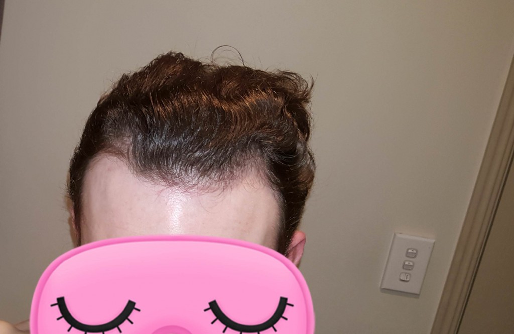 does finasteride stop hair loss immediately reddit
