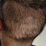 My Donor Area Is Very, Very Thin After My 4000 FUE Surgery, Why Is That?  (Photo) – WRassman,. BaldingBlog