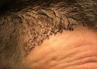 What do I do about my scabs now 9 days after my hair transplant? (photo) –  WRassman,. BaldingBlog
