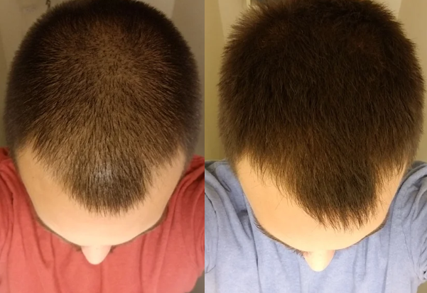 does finasteride stop hair loss immediately reddit