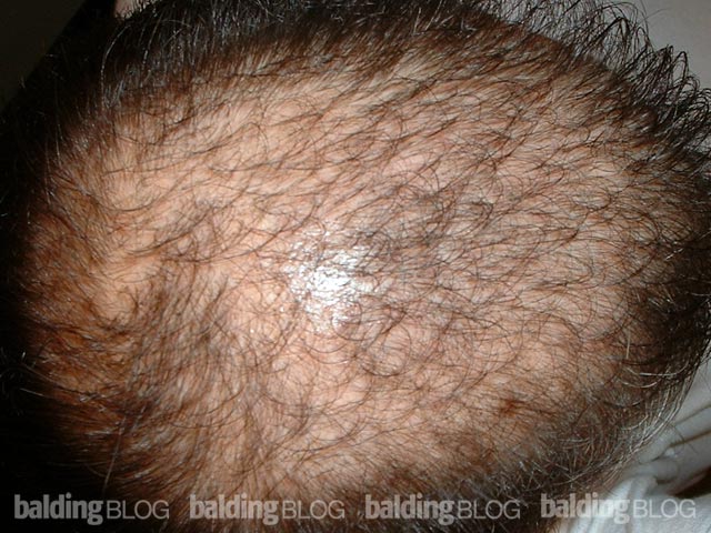 Hair Loss and Accutane, Part 2 – WRassman,. BaldingBlog