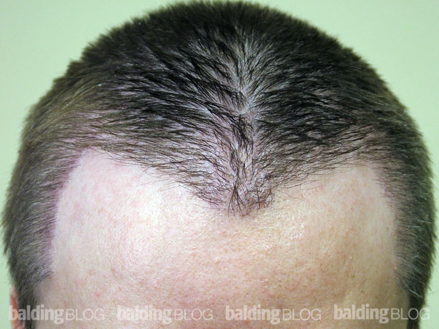 Celebrity Hair Transplants – WRassman,. BaldingBlog