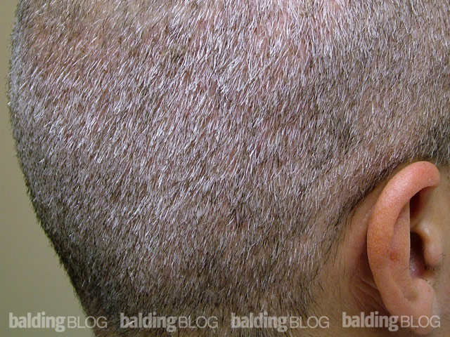 Shaving Head After FUE Procedure – WRassman,. BaldingBlog