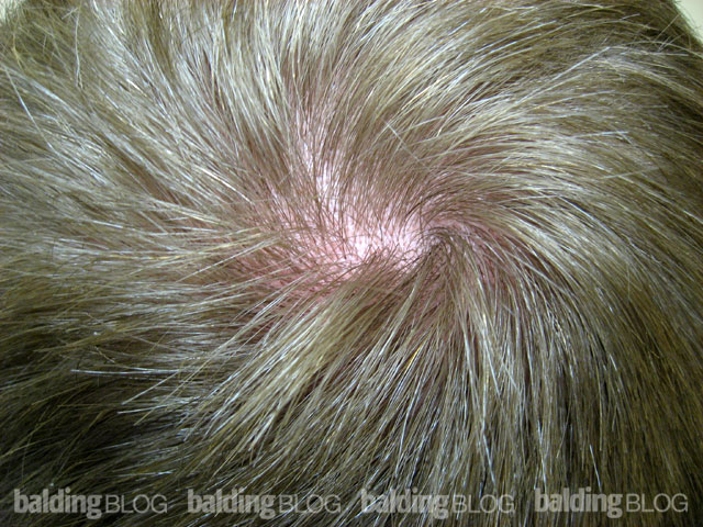 Cowlick Gives a Bald Spot Appearance – WRassman,. BaldingBlog