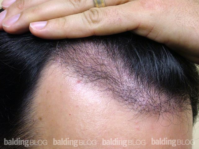 The “Baby” Hairs — 5 Months After Hair Transplant (with Photos) –  WRassman,. BaldingBlog