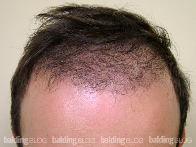 The “Baby” Hairs — 5 Months After Hair Transplant (with Photos) –  WRassman,. BaldingBlog