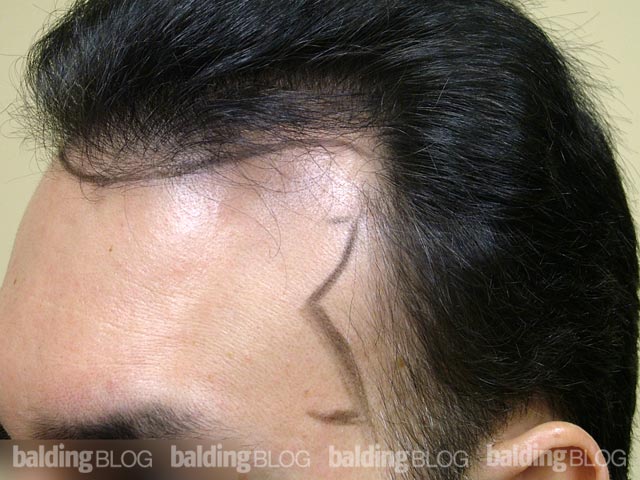 Reshaping the Temples with Hair Transplants – WRassman,. BaldingBlog